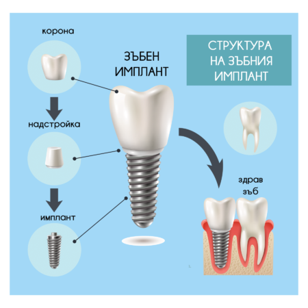 Структура зъбен имплант